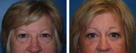 plastic surgeon dayton ohio|Before & After Gallery 